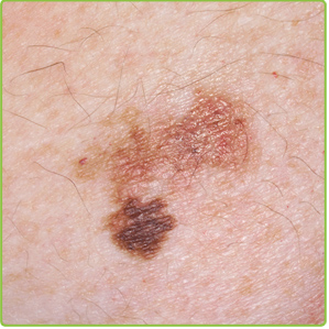 How do you find pictures of abnormal skin moles?